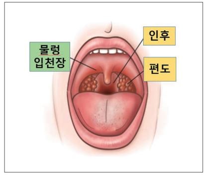 편도와 인후염의 주요 차이점과 공통 증상 비교
