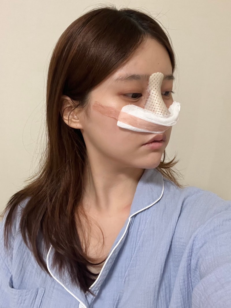[코 성형 후기]수술 당일~5일차/낮은 코 성형 솔직한 찐 후기/코 수술 준비물&꿀팁 : 네이버 블로그