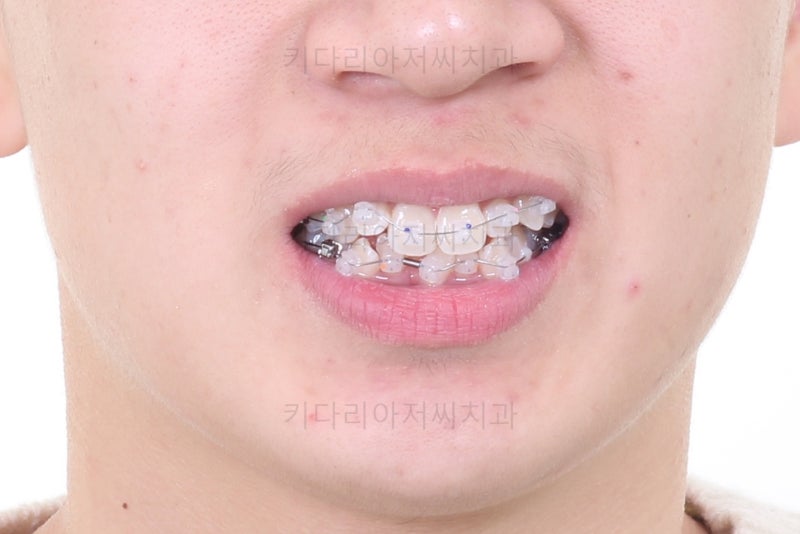 부산 청소년 치아교정 키다리아저씨치과의 덧니교정 사례