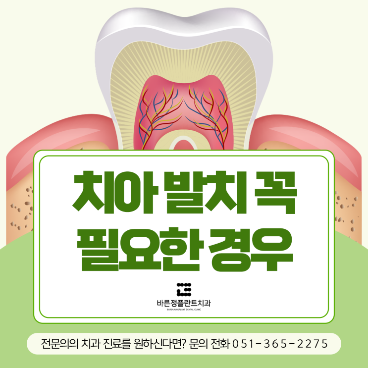  연산동치과 치아 발치가 꼭 필요한 경우는?