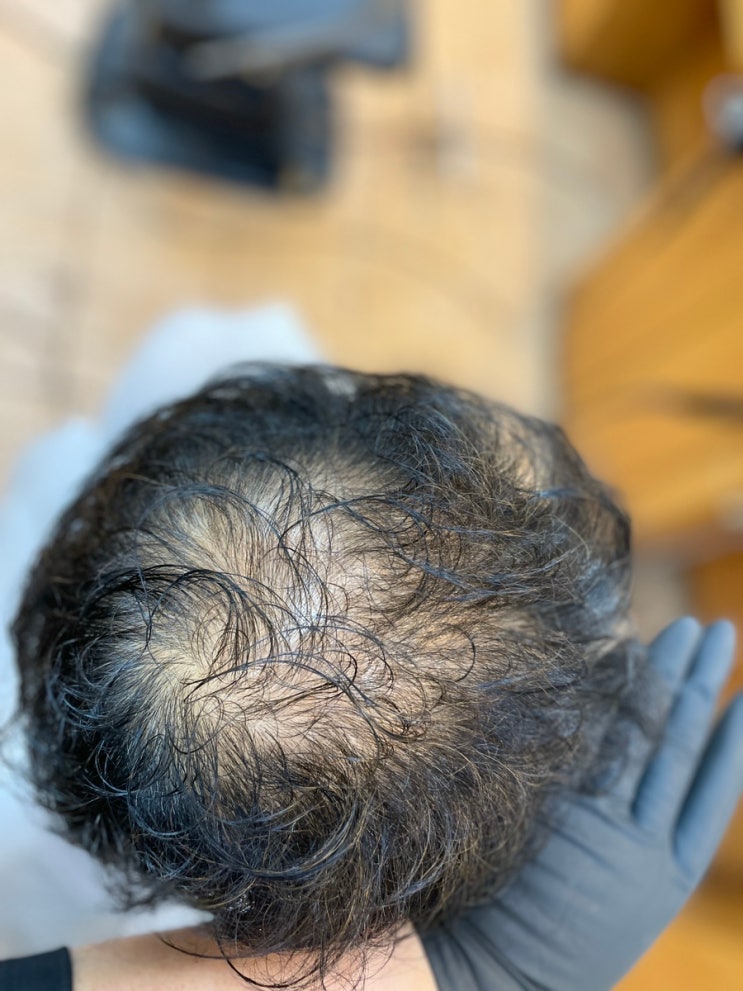  오래된중년탈모 내일부터는 꽃중년으로 부산탈모커버성형펌/ 사상탈모모라탈모하단탈모김해탈모거제탈모울산탈모양산탈모녹산탈모연제탈모동래탈모명륜탈모남구탈모수영탈모해운대탈모진구탈모당감탈모개금탈모