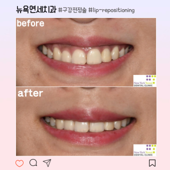  [강남역 잇몸성형] 웃을 때 과한 잇몸 해결방법 (feat.구강전정술, 입술재배치술)