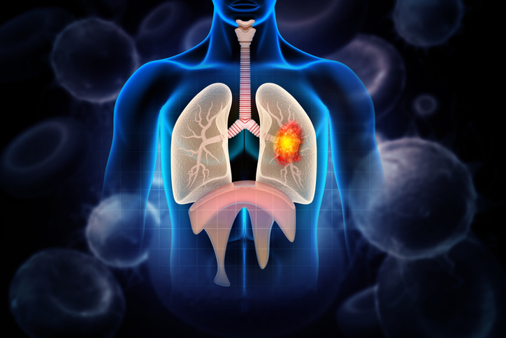  폐암 치료방법_국가암정보센터(cancer.go.kr)