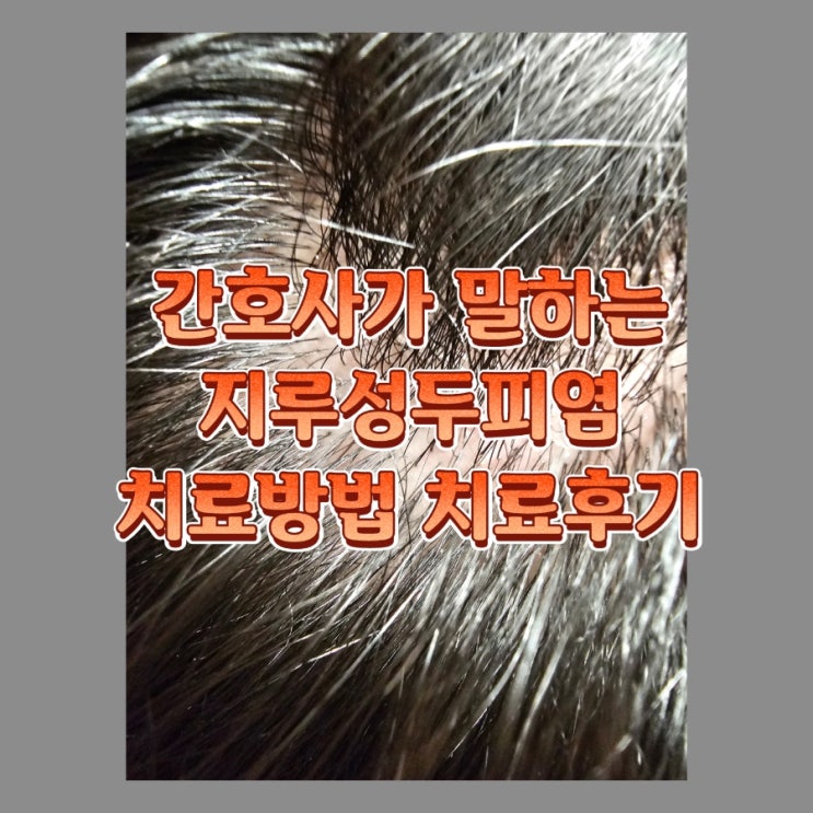  간호사가 직접 겪은 지루성두피염 (증상, 처방, 치료 방법, 치료 후기)