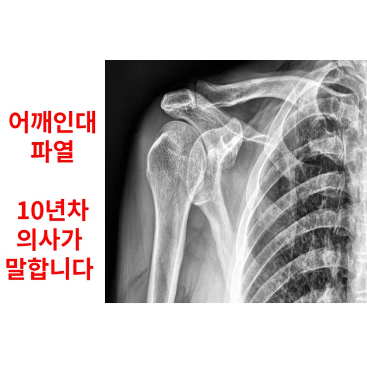 어깨인대파열수술, 10년차 의사가 말합니다
