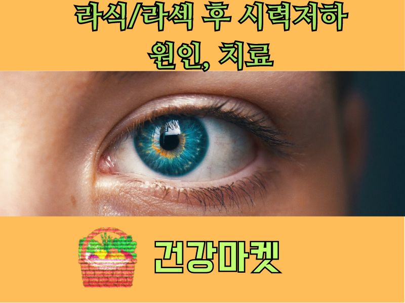 라섹후 시력저하 라식후 시력저하 이유 3가지