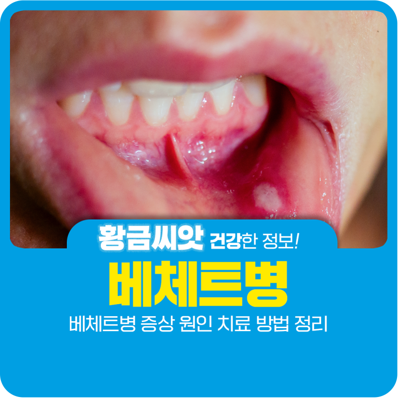 베체트병 증상 원인 치료 방법 정리