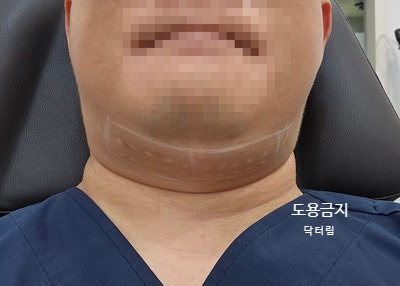  [삼성중앙역 피부과전문의] 이중턱 브이올렛주사 + 슈링크를 조합한 시술법, 직접 받은 후기 - 닥터림