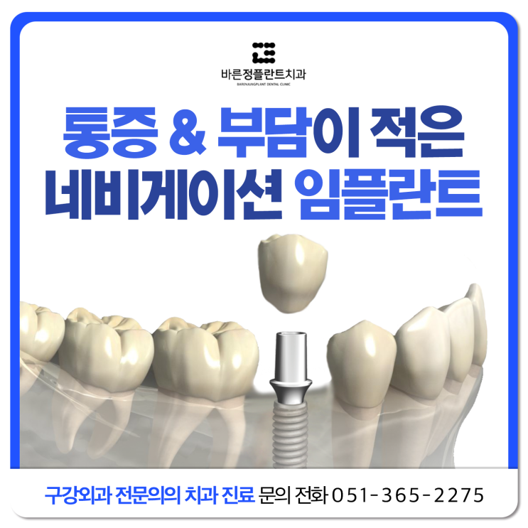  부산북구 구포치과 통증과 부담이 적은 네비게이션 임플란트