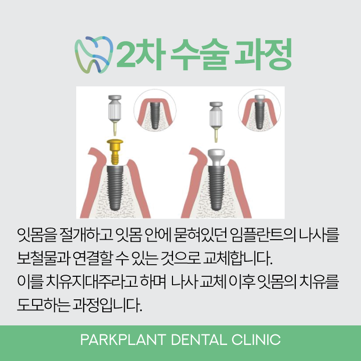 임플란트 이차 수술 특정 확인 방법 임플란트 이차 수술 특정 확인 방법