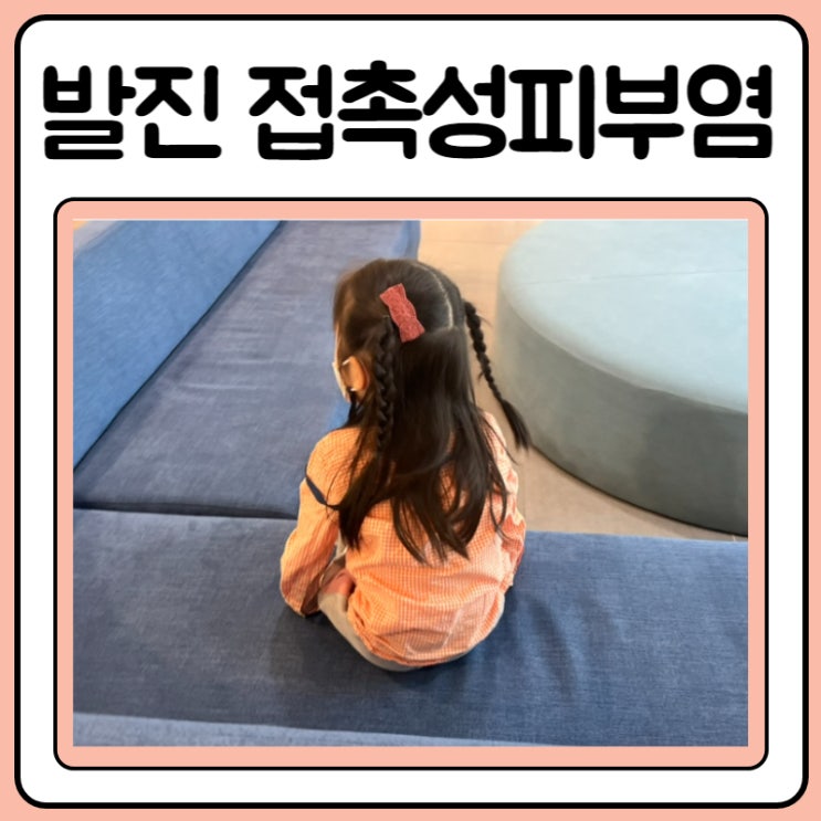  여아 생식기 발진 접촉성피부염 라벤다크림 받았어요