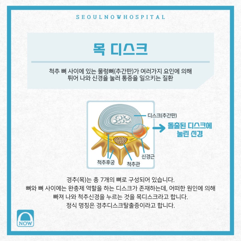 목 디스크 성형을 주저하는 경우