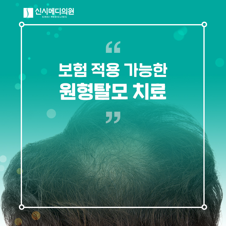  전주원형탈모 보험 적용 가능한 주사치료를 고려해보세요!