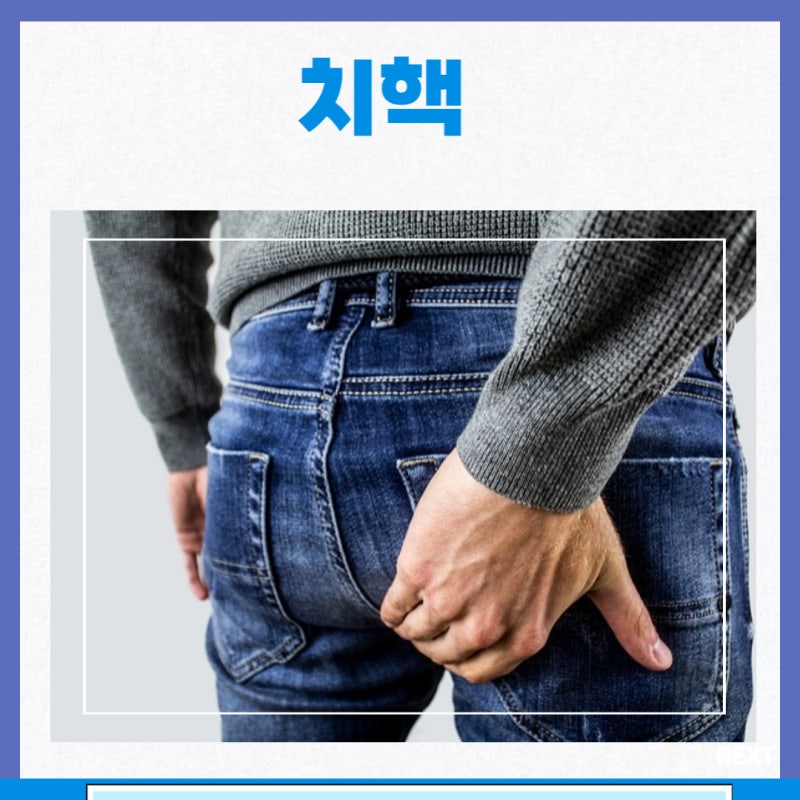 치핵 종류 내치핵 외치핵 혼합치핵 원인 증상 검사 수술 치료 1기 2기 3기 4기 : 네이버 블로그