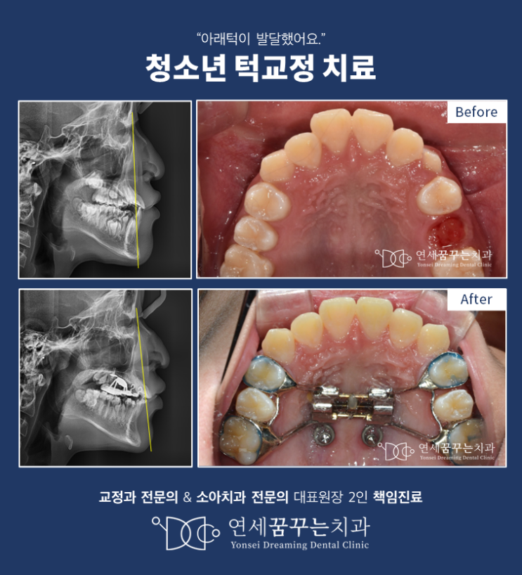 청소년 부정교합 주걱턱 교정을 성공적으로 하기 위한 조건, 성장분석이 필요한 이유!