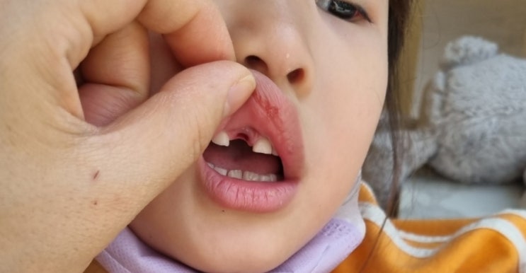 열성경련 아관긴급 후 앞니발치