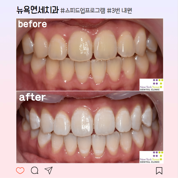 [강남역 치아미백] 안전한 치과미백 효과가 있을까? (feat.전문가미백)