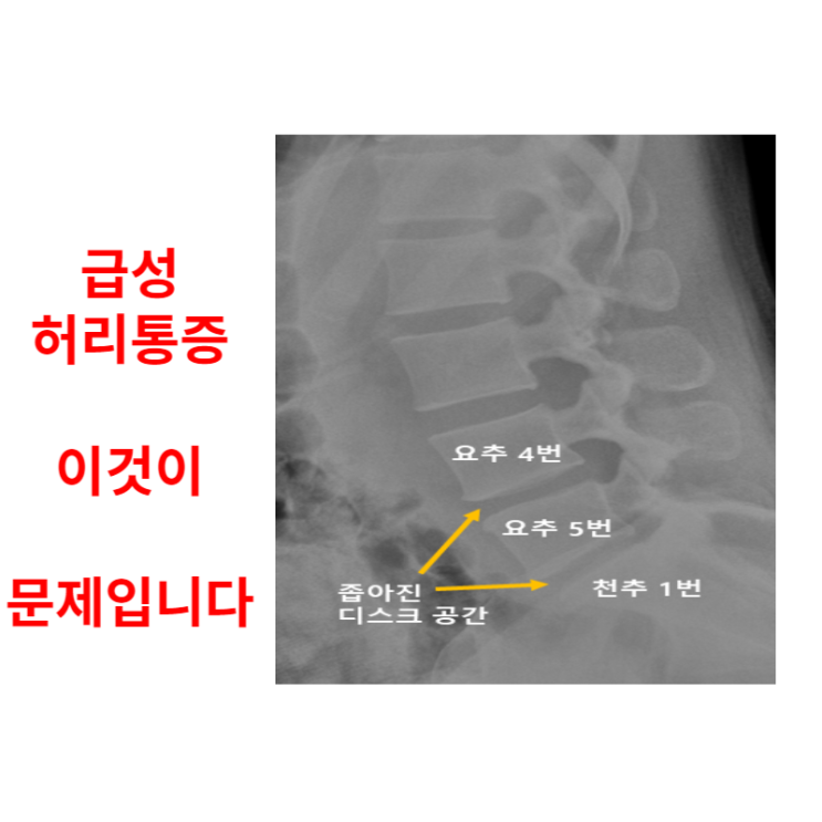  광주 급성허리통증? 갑자기 아파요