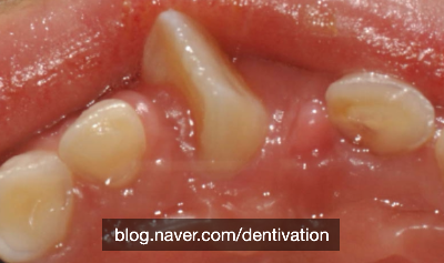덧니의 종류 (1) 회전된 치아 - Rotation, 치아교정, 부정교합
