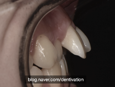 덧니의 종류 (2) 기울어진 치아 - 뻐드렁니, 경사치, 토끼이빨, inclined tooth