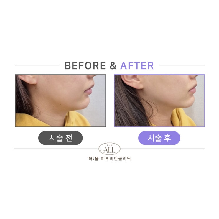  안산피부과 탄력리프팅 브이라인이 살아나는 하이푸초음파 리니어펌 효과