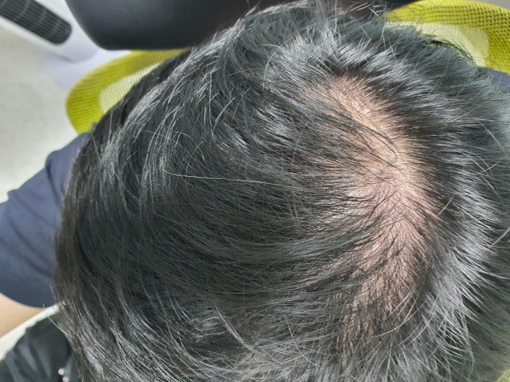  커클랜드 미녹시딜 5% 6년차 사용 후기 : 탈모가 있는 나를 위한 선택! 미녹시딜 직구 가격 및 미녹시딜 부작용 효과 사용법 완벽정리