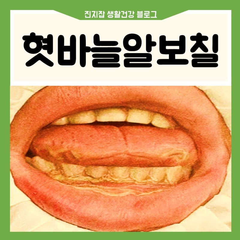 혓바늘 알보칠 약 연고 뽑기 없애는법