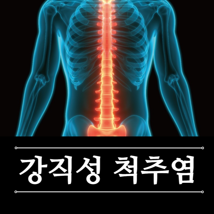 강직성 척추염 검사 증상 원인 진단 치료 완치 가능할까 강직성 척추염 검사 증상 원인 진단 치료 완치 가능할까