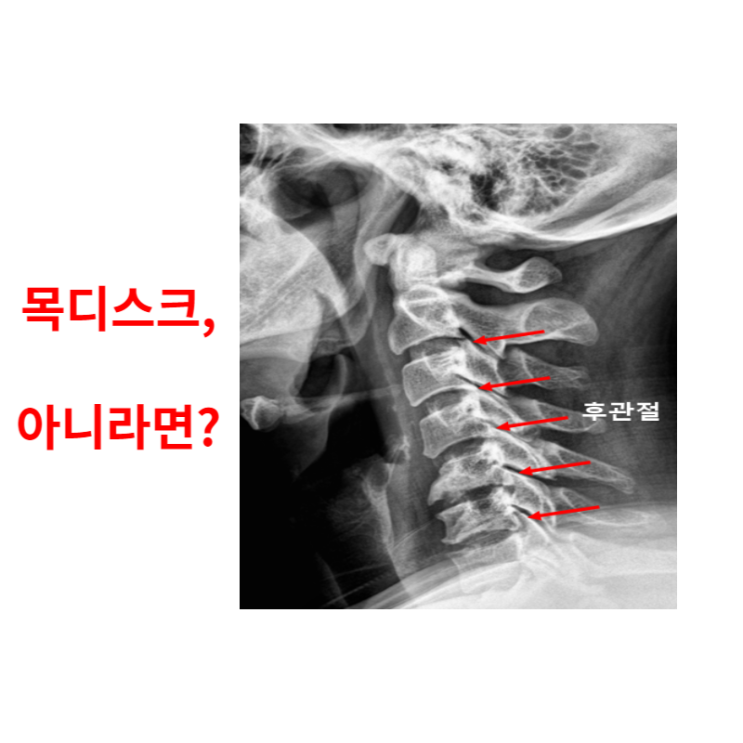  경추후관절증후군, 목디스크가 아닐 수 있습니다