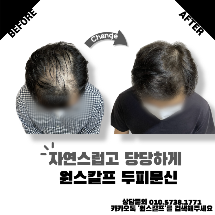  사직 두피 문신 진짜 잘 하는 곳은?