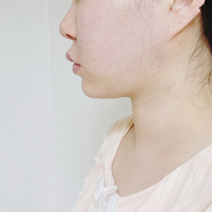  프레쉬성형외과 이중턱 귀밑 얼굴지방흡입후기 3달차