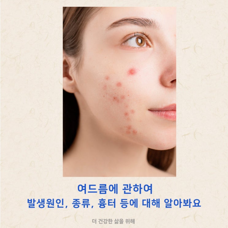여드름 발생 원인, 종류, 흉터, 치료방법에 대해 알아봐요