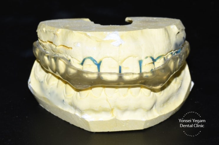  Teeth grinding, Bruxism: Botox, Night Guard in Seoul /  price