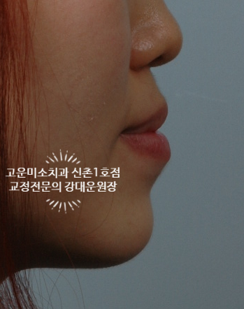  주걱턱과 돌출입을 동반한 비수술 발치교정치료 3급부정교합치료 신촌 교정전문의 강대운원장 고운미소치과 신촌1호점 치료증례