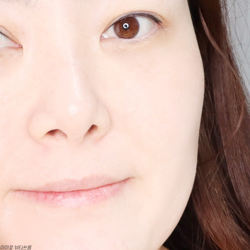 우르셀라효과 내금내산 턱선미용 피부리프팅 피부과 케어리뷰