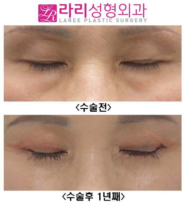 라리성형외과] 상안검, 트임없는앞트임, 뒤트임재수술, 눈밑지방재배치수술 다 한 번에 할 수 있습니다. 좋은 결과로 회복 가능해요 ! :  네이버 블로그