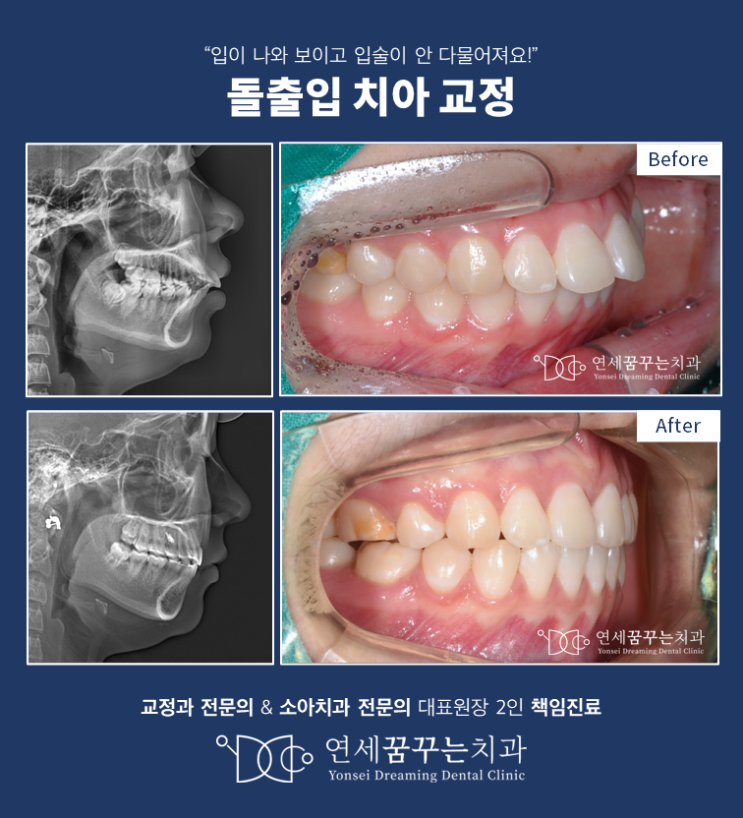 치아 돌출로 입이 안 다물어진다면? 돌출입 교정치료의 과정과 변화