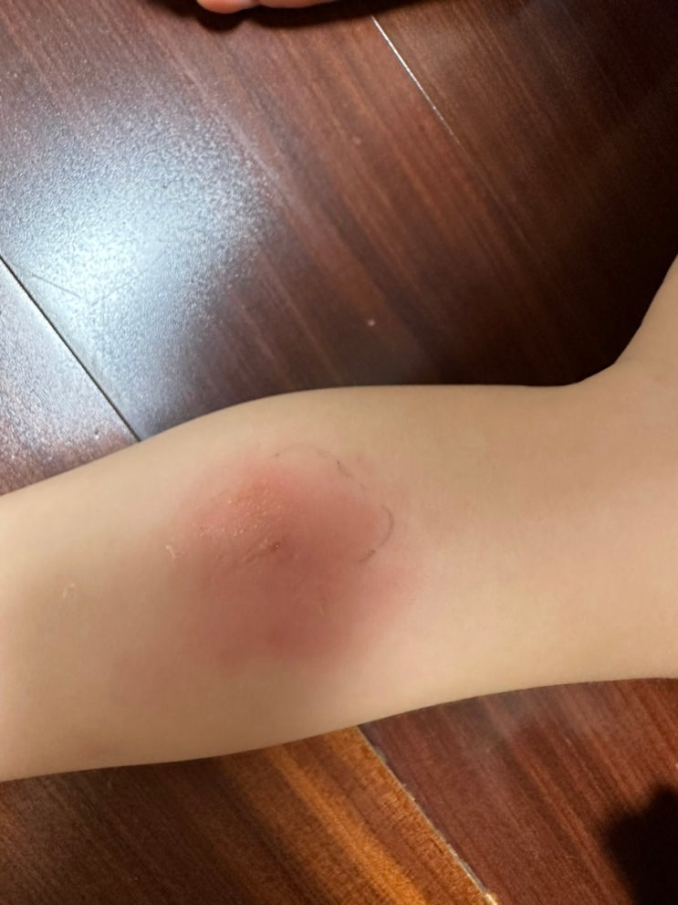  아기 아이 모기 물렸을 때, 모기 물린 후 물집 생겼을 때, 중국모기 물린 후 처치 방법