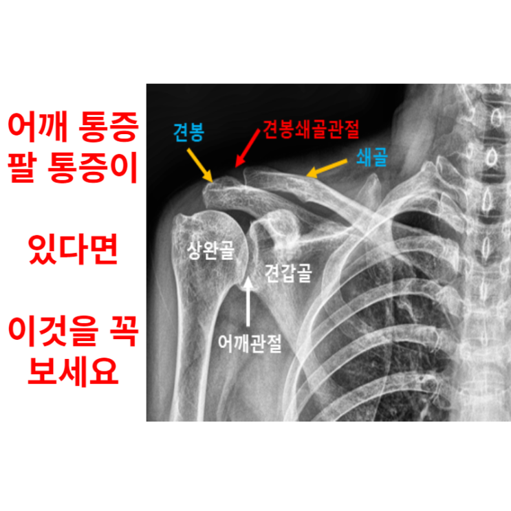  견봉쇄골관절염, 어깨 문제 있다면 꼭 읽어보세요