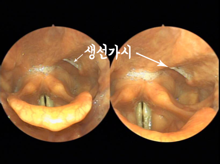  목에 생선 가시 걸렸을 때 하면 안되는 행동