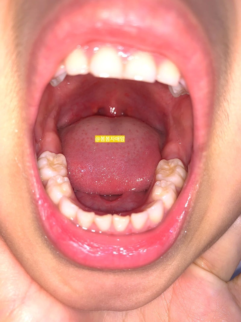 아기 구내염 헤르판지나 증상 열 진행 감염 초등학교 유아 구내염 빠르게 낫는 방법 목 물집 사진