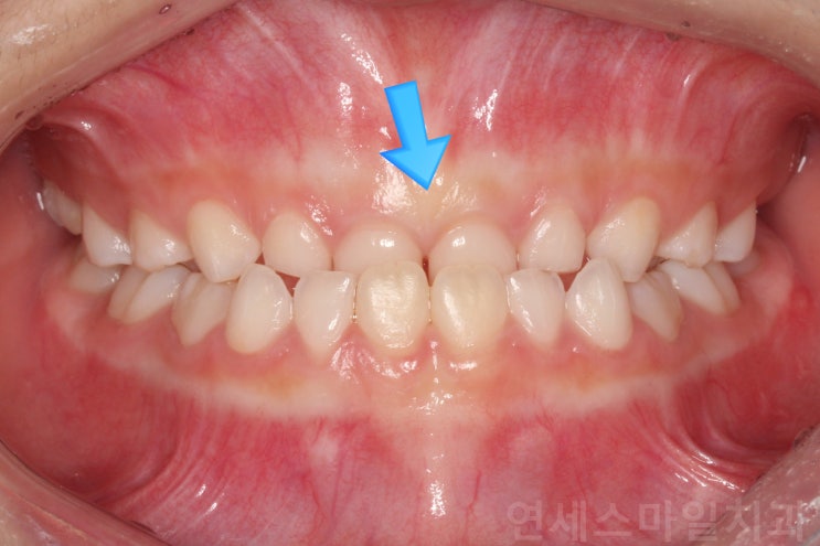  중계동치과, 초등학생 치아교정, 이가 거꾸로 물려요, 주걱턱 교정시기