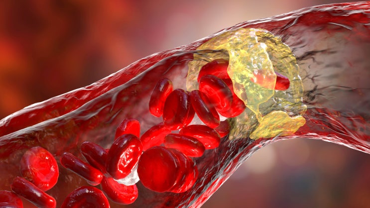  심혈관질환 호모시스테인 검사로(Homocysteine)로 평가해보시는건 어떨까요?