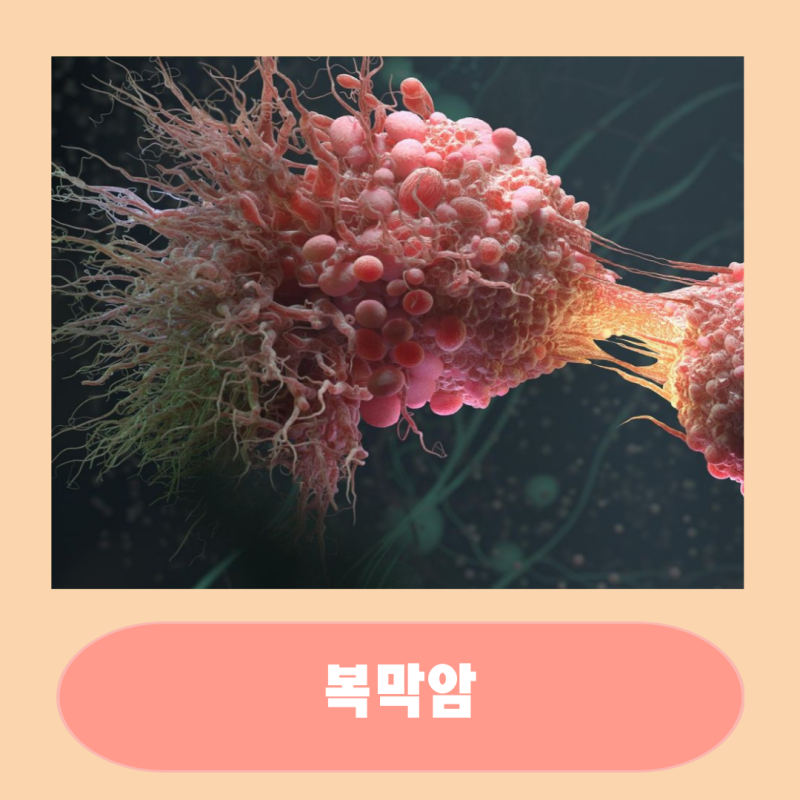 복막암 기본 정보 증상 원인 생존율 총정리