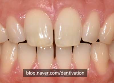 치아가 너무 작을 때 부정교합이 발생합니다 - 치아덧니 치아교정