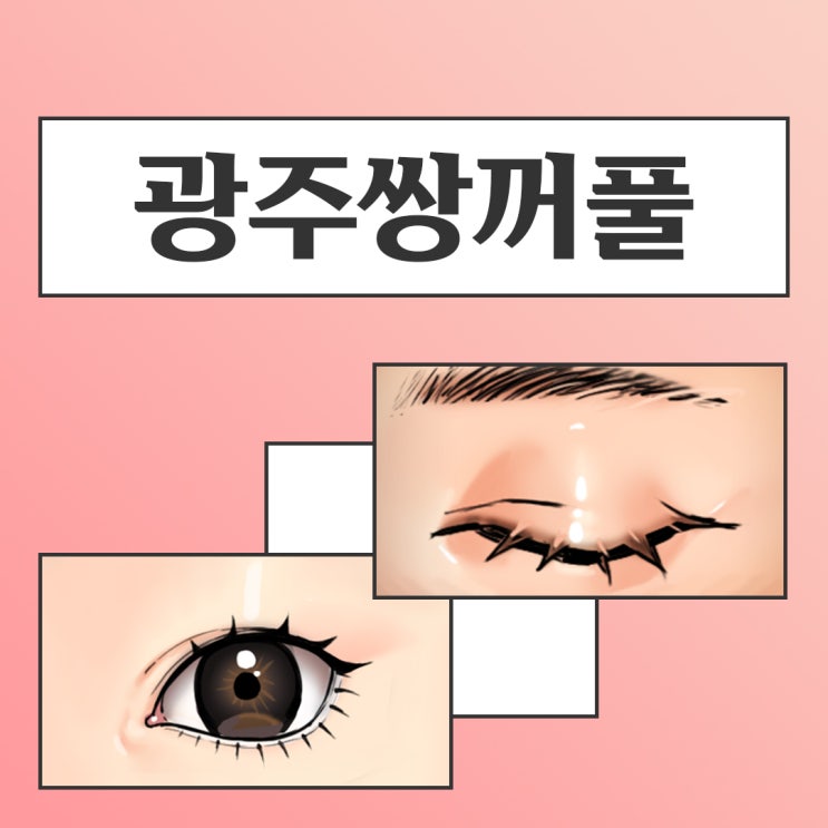  광주쌍꺼풀, 자연스러운 눈성형으로 라인 개선!
