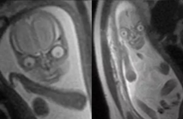 태아 초음파 대신 찍은 MRI 사진 부모 '경악'
