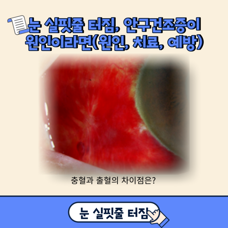 눈 실핏줄 터짐, 안구건조증이 원인이라면(원인, 치료, 예방)