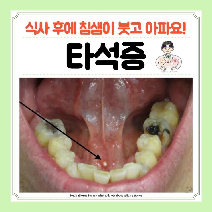  침샘 타석증 침샘돌 침샘결석 원인 증상 수술