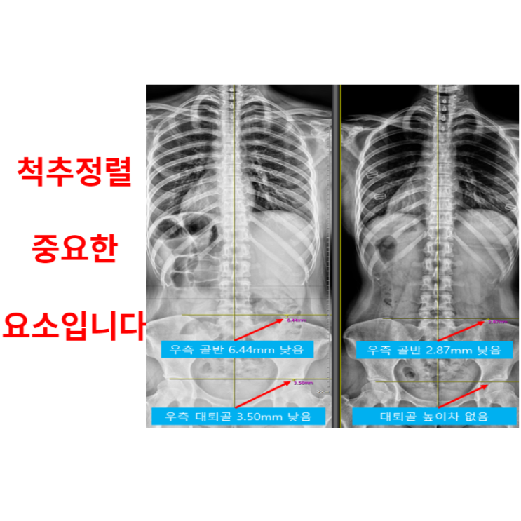  광주도수치료, 척추정렬을 바로 잡아야만 하는 이유